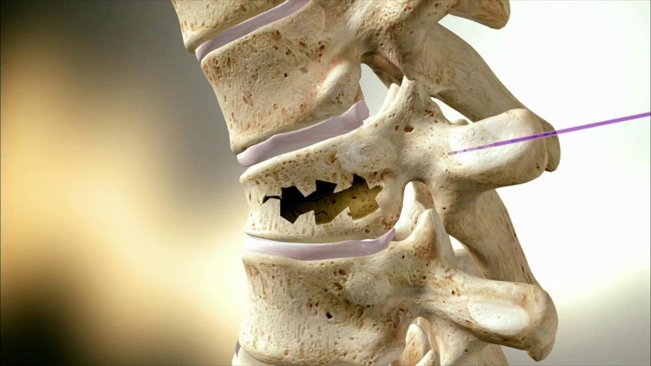 Damaged spinal disk