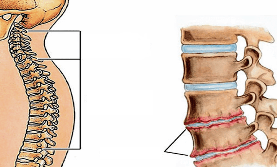 What does the spinal fibrosis look like 