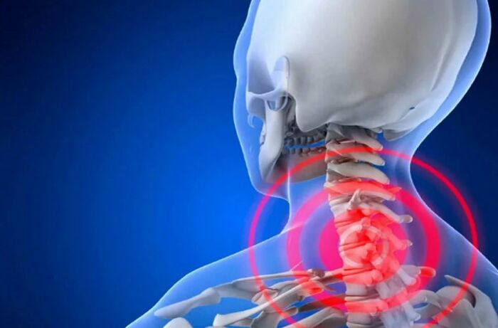 Linkrosis of cervical spine