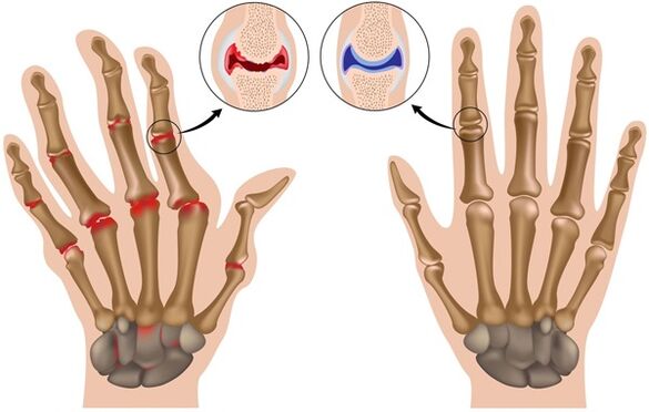 Finger deformity due to arthritis
