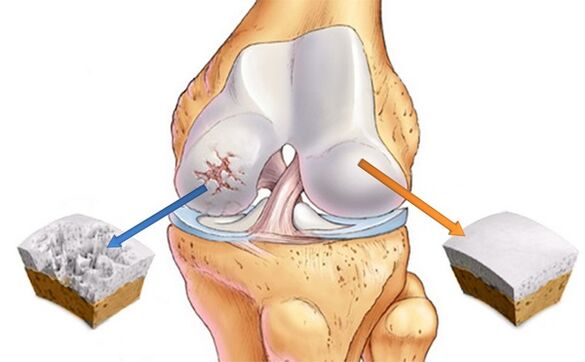 healthy cartilage and cartilage affected by arthritis