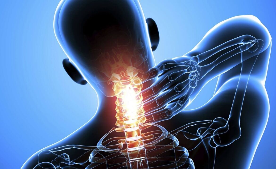 Spine damage due to cervical spondylosis