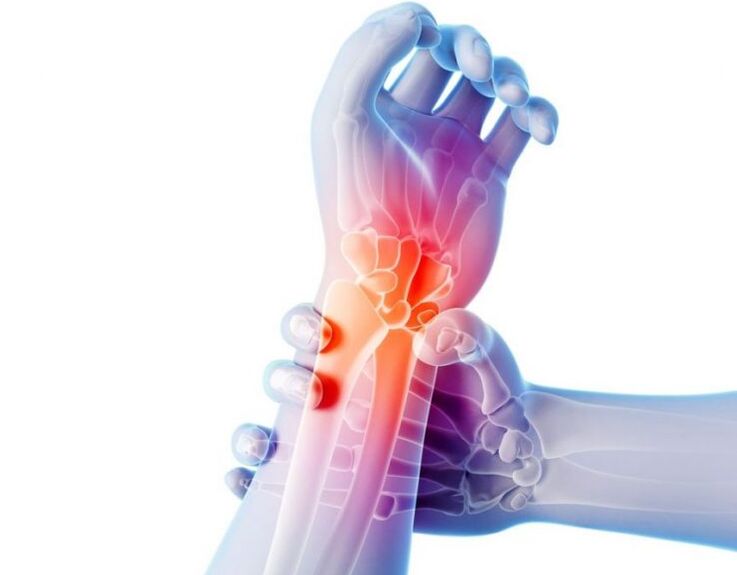 Arthritis is accompanied by pain and requires complex treatment