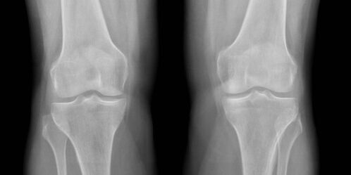 Knee arthritis on X-ray