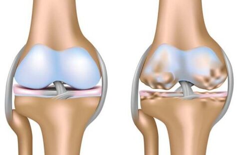 healthy joints and knee joint destruction due to arthritis