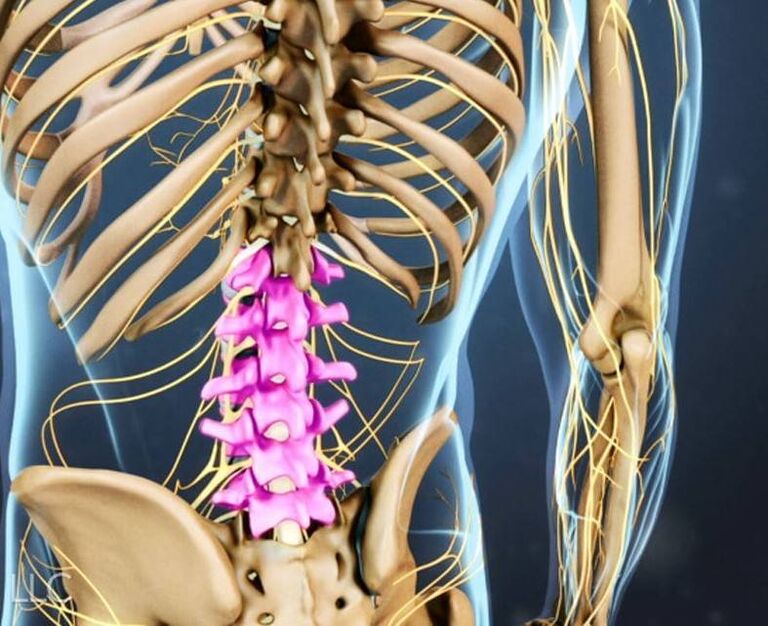 Lumbar spine degeneration